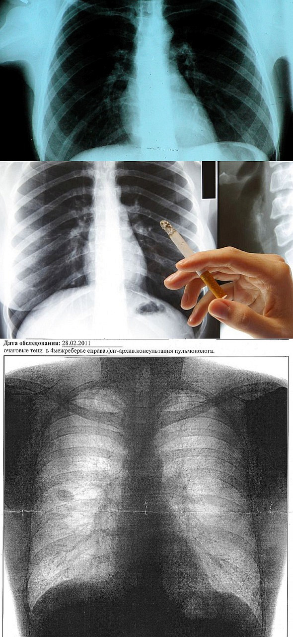 Флюорография фото здоровых легких и больных